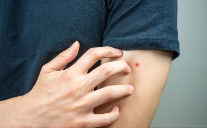 Person scratching a red, swollen insect bite on their upper arm