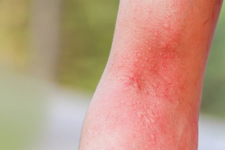 Red, irritated skin with bumps, likely from insect bites or rash