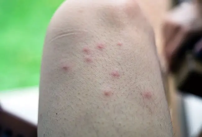 common view of mosquito bite