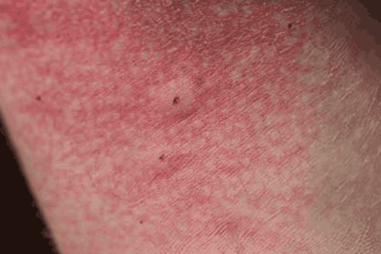 spider bite puncture on skin