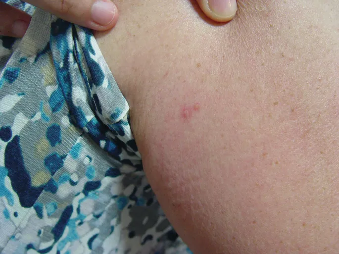 Close-up of a skin bite mark, possibly from a house centipede, showing redness and slight swelling.
