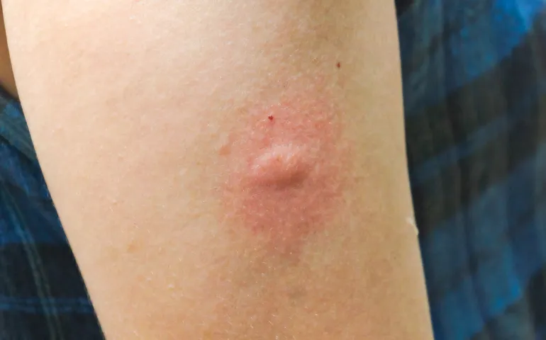 Red swollen bump on skin resembling a cockroach bite.