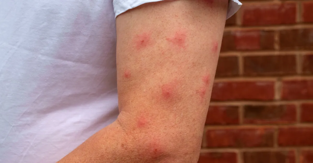 close up of an arm with mosquito bites