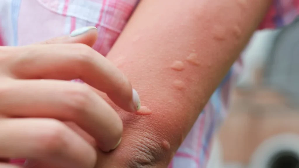 close up of an arm with several cockroach bites