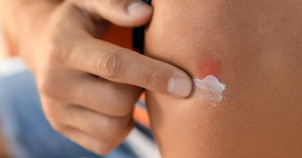 view of a hand applying ointment on a cockroach bite