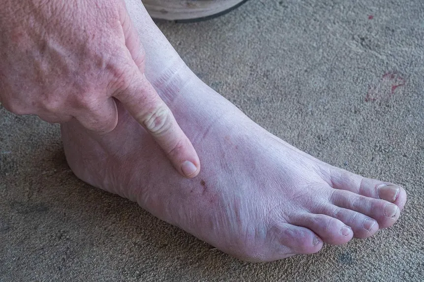 zoom in view of centipede bite on a foot, hand pointing toward it